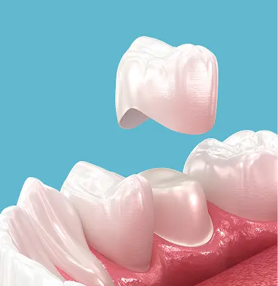 Full-Arch Implant Restorations (All-on-X)