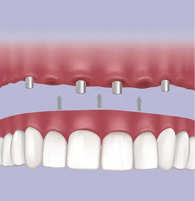 Implant Overdentures