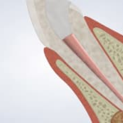 Implant Overdentures